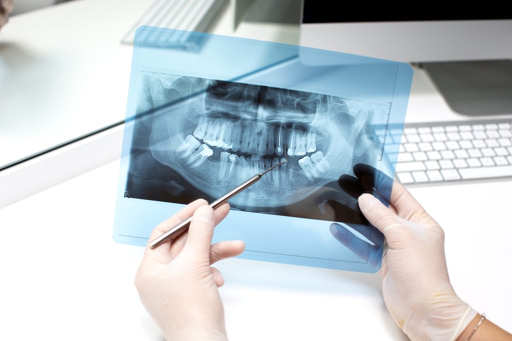 Имплантация зубов Вильнюс, Dental implantation